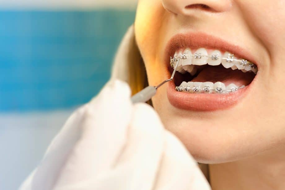 Adult Braces: Are They Right for You
