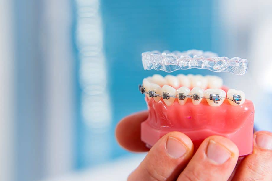 Can You Switch From Braces to Invisalign Mid-Treatment?
