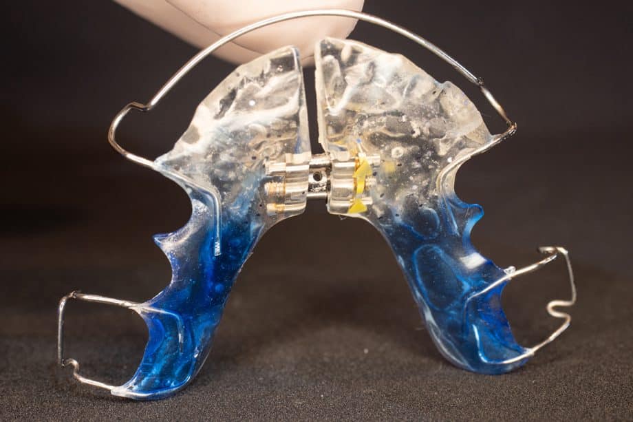 Does a Palate Expander Hurt?
