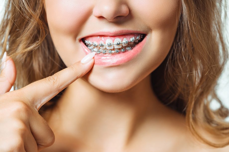 young woman pointing to her metal braces