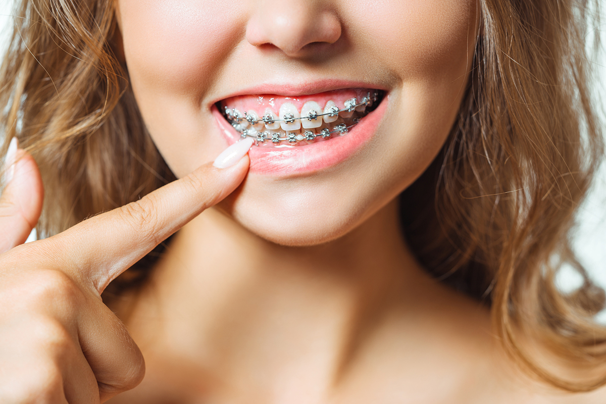 When Is It Too Late to Get Braces? Hass Family Orthodontics